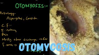 OTOMYCOSIS  Fungal Ear Infection [upl. by Munmro420]