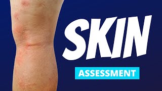 Skin Focused Nursing Assessment  The Most Common Findings [upl. by Sada]