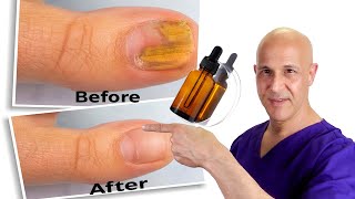 1 Oil Cures Toe Nail Fungus  Dr Mandell [upl. by Hplar666]