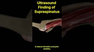 Ultrasound is The Key To Diagnosing Rotator Cuff Supraspinatus [upl. by Meade]