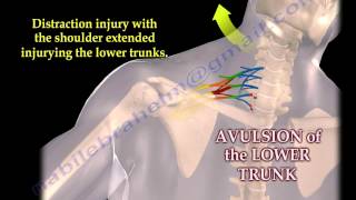 Brachial Plexus Mechanism Of Injury  Everything You Need To Know  Dr Nabil Ebraheim [upl. by Ylsel926]