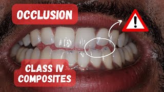 Occlusion on Class IV Composite Restorations  PDP150 [upl. by Fidellia314]