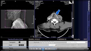 CT scan of larynx and hypopharynx Neck format [upl. by Thornie21]