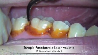 Terapia Parodontale Laser Assistita [upl. by Kinson]