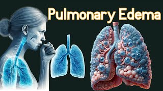 Pulmonary Edema Fluid In the Lungs Symptoms amp causes [upl. by Anilehcim]