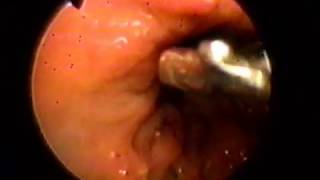 Pelican Endoscopy Removal of foreign bodies [upl. by Abie]