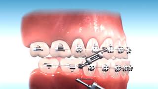 How to correct Class III Malocclusion [upl. by Nannek]