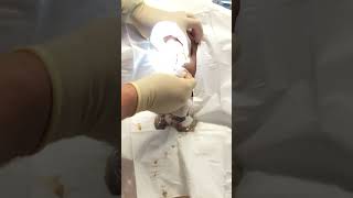 Exploding grapefruit sized sebaceous cyst popping [upl. by Landel]