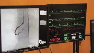 Cardiac Catheterisation Part 2  Right Coronary [upl. by Adella]