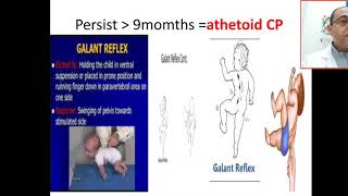 whats spinal galant reflex if persist  athetoid CP learning difficulty bedwetting hyperactive [upl. by Negah768]