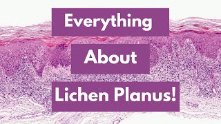 Oral Lichen Planus Introduction Etiology Clinical Features Diagnosis Management [upl. by Ekaj]