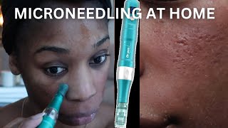 MICRONEEDLING AT HOME TIPS WARNINGS DEMO [upl. by Menzies304]