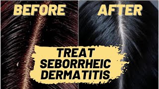 How to Treat Seborrheic Dermatitis Natural Hair Treatment  Repair Your Scalp amp Hair Loss [upl. by Billat]