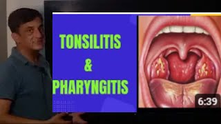 Tonsillitis  Pharyngitis  Urdu  Hindi [upl. by Sirc]