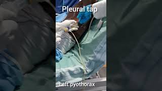 left pyothorax in a patient of Diabetes with TB Pleural tap [upl. by Airrehs]