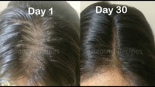 Vitamin E Oil  Onion juice for Hair Growth Long Hair Thick hair Regrow lost hair from roots [upl. by Yelahc]