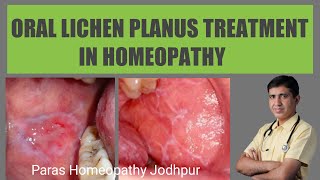 Heal Your Oral Lichen Planus With Homeopathy [upl. by Jo-Anne]