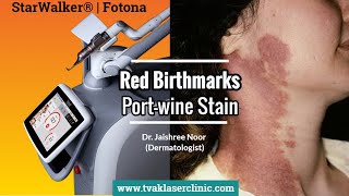 Red Birthmark  PortWine Stain Removal in Delhi  Dr Jaishree Noor  Tvak Laser Clinic [upl. by Latsyrd]