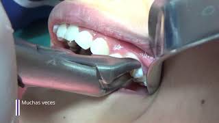 Extracción dental en niñosExtracción de dientes temporales [upl. by Aneelas]