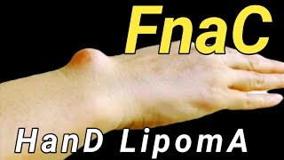 Fnac of Hand Lipoma ।। [upl. by Kyl]