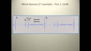 Examples of mitral stenosis murmurs [upl. by O'Toole]