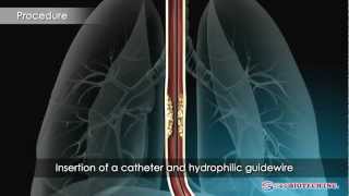 SampG BiotechEGIS Esophageal Stent [upl. by Adamo]