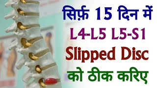 L4  L5  S1 Slipped Disc Treatment  Cure Slipped Disc  Herniated Disc In 15 Days [upl. by Ellac]