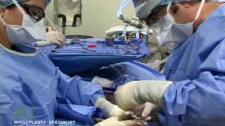 Dr Nassifs Closed Rhinoplasty How To  Septoplasty [upl. by Margherita184]