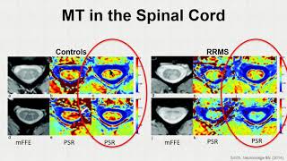 ISMRM MR Academy  Quantitative Magnetization Transfer Imaging for Characterizing Pathology [upl. by Caresa]