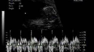 twin babies ultrasound 17 weeks [upl. by Leizahaj437]