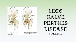 Perthes disease  clinical features investigation Waldenstrom staging Herring classification [upl. by Lrad]