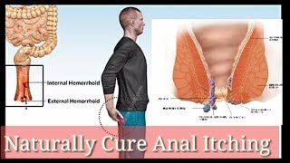 Naturally Cure Anal ItchingHow To Remove Anal Itching At 🏡 [upl. by Michey]