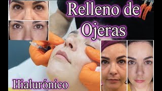 Relleno de Ojeras con Hialurónico  Carboxiterapia [upl. by Kiefer]