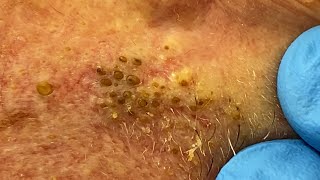 Extremely Clogged Pores Extracted  Contour Dermatology [upl. by Lussier40]