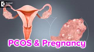 What happens if I have PCOS and I get pregnant  Dr Bala R [upl. by Anirav]