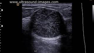 Phyllodes tumor ultrasound video [upl. by Cheshire]