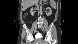 Ct Urogram Excretory coronal [upl. by Eneres]