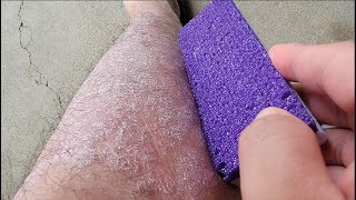 Purple Pumice vs Psoriasis Skin Flakes [upl. by Arykahs]