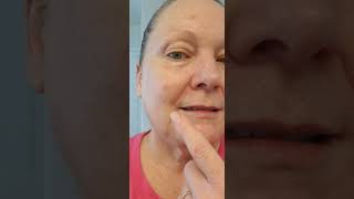 Healing on day 67 after a 21 day treatment of 5 Fluorourcil for Basal Cell Carcinoma 5FU 3132023 [upl. by Annasor]