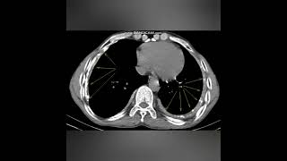 TUBERCULOUS EMPYEMACHRONIC  XRAY AND CT IMAGEA new case every daySame time tomorrow [upl. by Dredi]