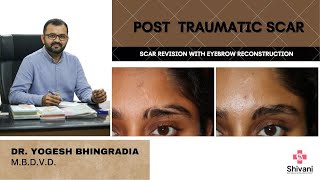 TRAUMATIC SCAR  EYEBROW DISRUPTION  SCAR REVISION  EYEBROW RECONSTRUCTION  DR YOGESH BHINGRADIA [upl. by Karim]