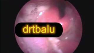 Acute epiglotititis [upl. by Welsh]