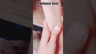 Mantoux test कैसे लगाएं ll [upl. by Dukey82]