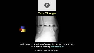 MRI of the Ankle Part 7 – Ankle Tendons [upl. by Leilamag]