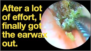 After a lot of effort I finally got the earwax outear wax removal  ear cleaning  ASMR  relax [upl. by Richarda]