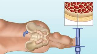 GraftVersusHost Disease by C Duncan  OPENPediatrics [upl. by Akcirret]