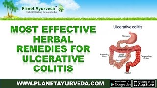 Top 10 Most Effective Herbs To Cure Ulcerative Colitis Naturally [upl. by Ellocin]