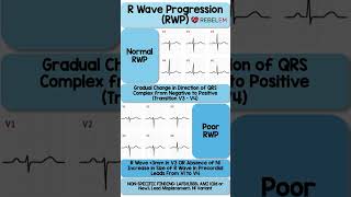 Normal vs Poor R Wave Progression RWP REBELEM ECG EKG RWaveProgression MedEd [upl. by Bobby403]