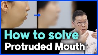 EN Protruded Mouth How to solve Protruded Mouth l Korean lantern jaw surgery case review [upl. by Elianore]