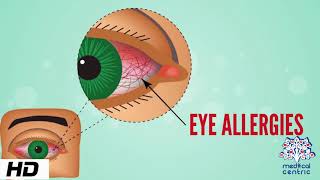 Eye Allergy Causes Signs and Symptoms Diagnosis and Treatment [upl. by Rube]